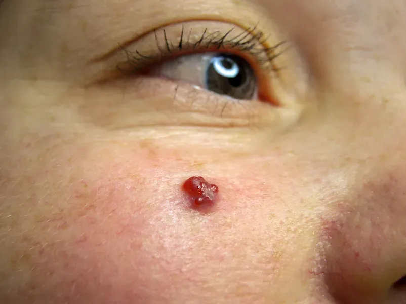 Laser Treatment for Angiomas