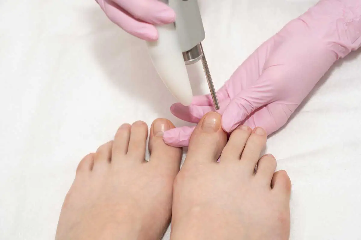 Laser Treatment for Nail Fungus