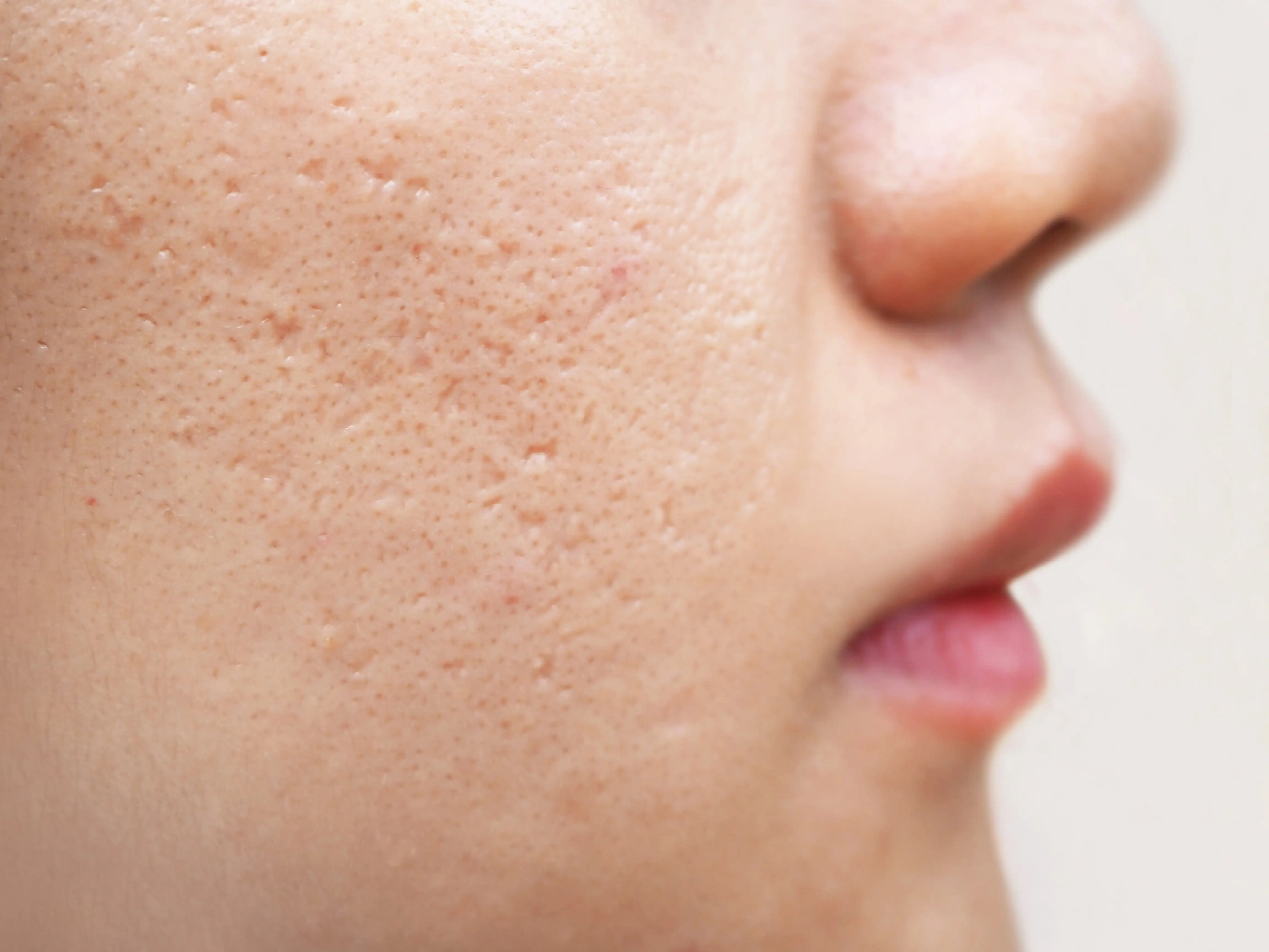 Acne Scars Treatment Image