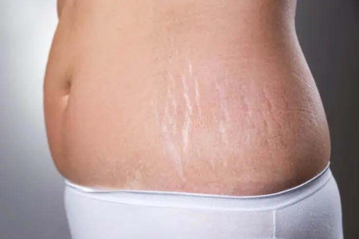 Stretch Marks Treatment Image