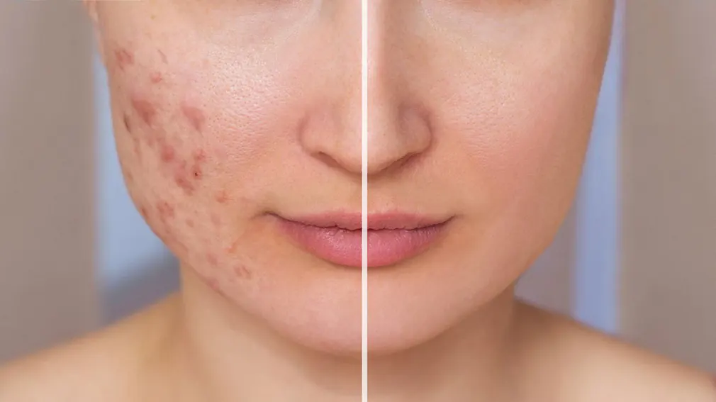 Acne Surgery Image